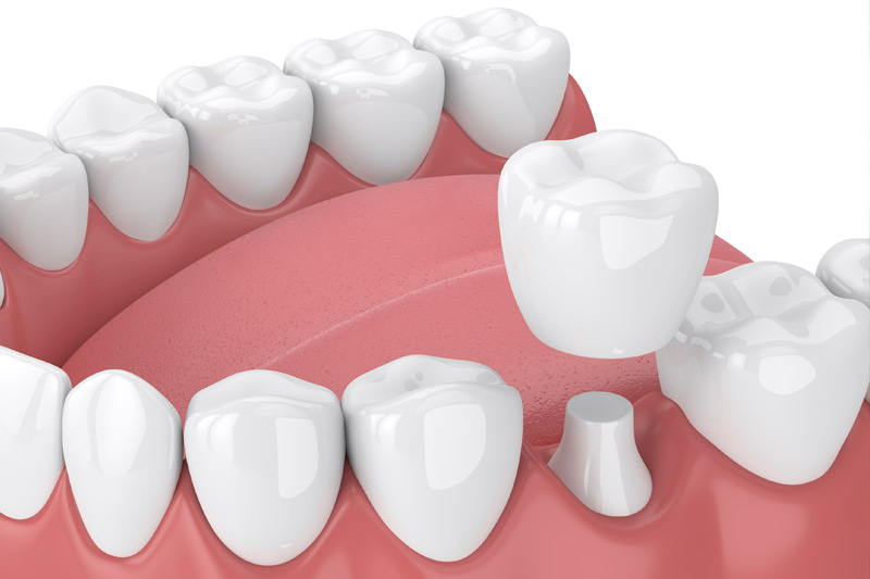 Dental Crowns in Massapequa