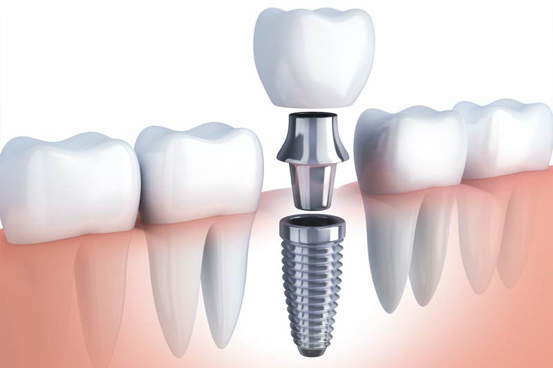 Implants Dentist in Massapequa